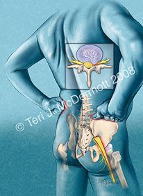 Low Back Pain 